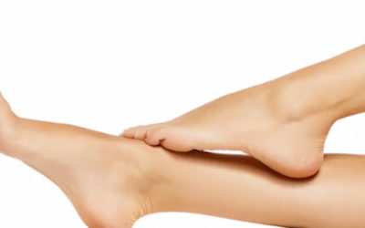 Varices, ¿qué son, ¿por qué se producen?, ¿se pueden prevenir?, ¿podemos tratarlas?