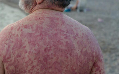 La psoriasis, esa enfermedad silenciosa que ya afecta a un millón de personas en España